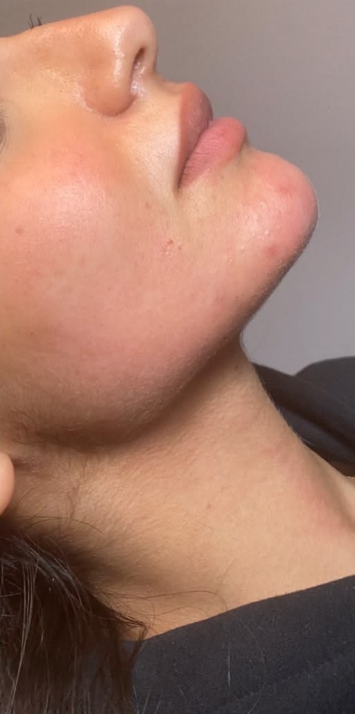 Dermal Fillers After treatment at Dexa Clinic